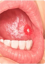 Medical illustration: a red or white patch