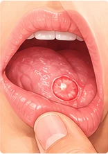 Medical illustration: a mouth ulcer that does not heal